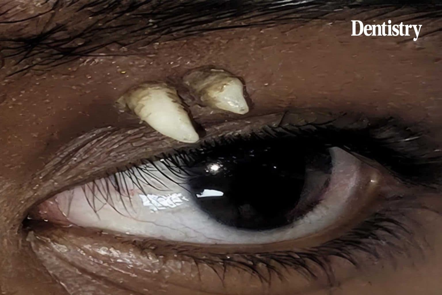 Surgeons remove rare ectopic tooth from teenager's eye socket